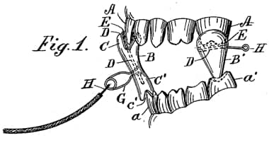 1897 Dental anaesthesia