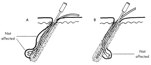 thermolysis