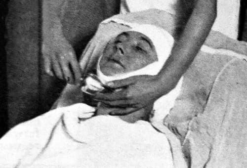 1930 Icene treatment
