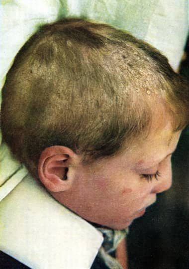 Favus of the scalp in a young child
