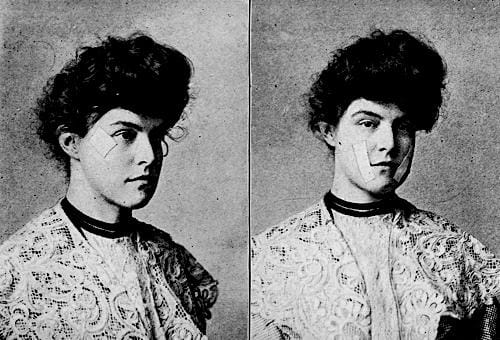 1905 Adhesive tapeused to remove facial lines
