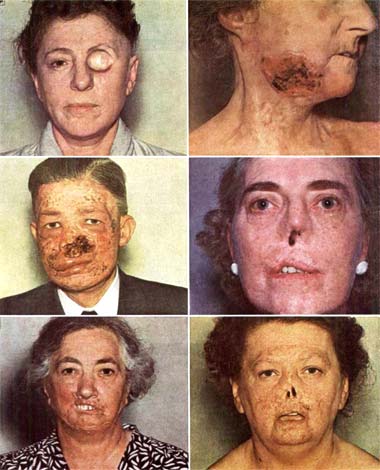 Facial cancers